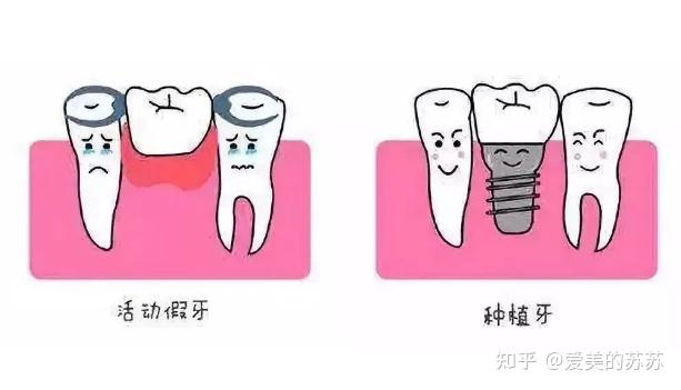 一般情况下,种植牙手术是一个较小的牙槽外科手术,类似拔牙,采用局部