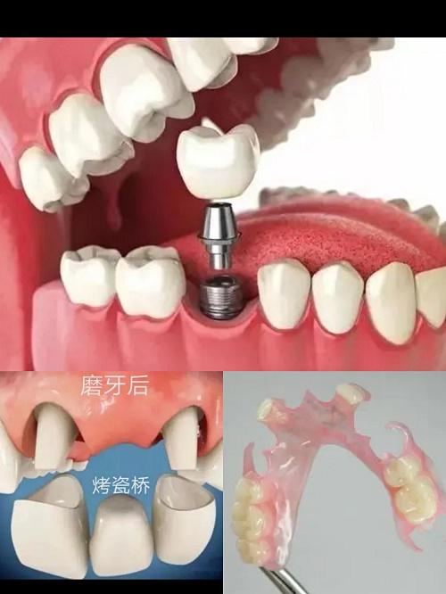 二,种植牙修复的效果好吗?