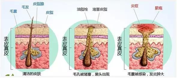 皮肤疾病,青春期发病率较高,临床表现不一,从生理性粉刺到炎症性丘疹