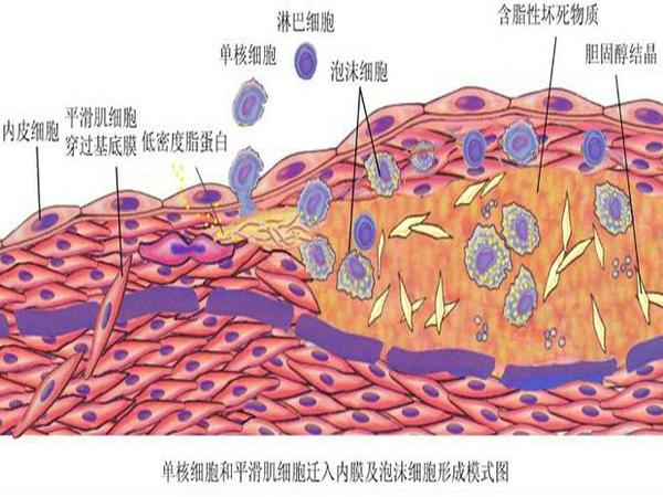 泡沫细胞的特点是什么?