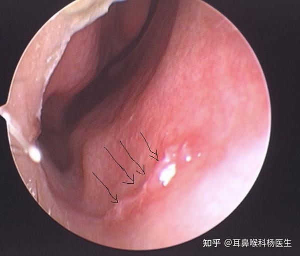 鼻子出血大多数是怎么回事?