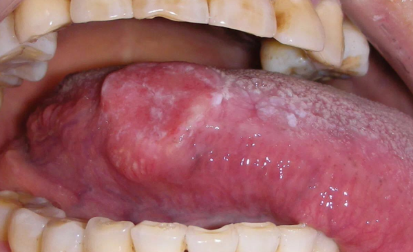 同样口腔清洁也是,抑制住病菌滋生,另外得小心舌头溃疡,通常2周内可以