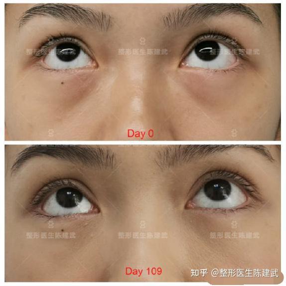 做完眼袋手术后46岁的眼睛逆生长让人眼前一亮