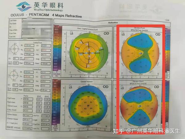 角膜地形图检查是近视手术前必查的一个项目,它可以有效筛查圆锥角膜