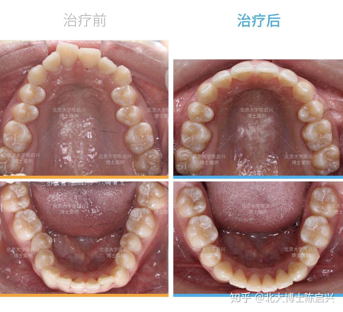 隐适美深覆合嘴突矫正案例