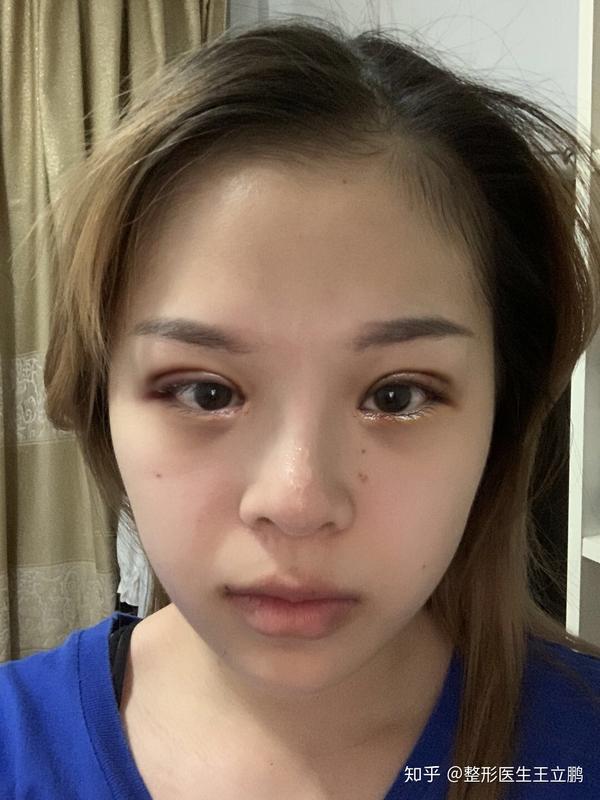 一双眼拯救一张脸,做完双眼皮一个月之后是什么样子?