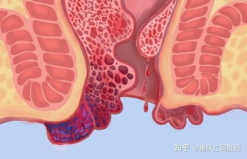 重庆仁同肛肠医院讲述肛门长疙瘩不痛不痒这可能是息肉