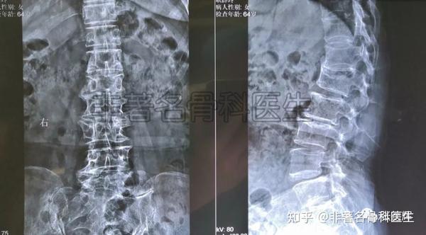 被"误判"的腰3-4椎间盘突出症及其脊柱内镜微创手术