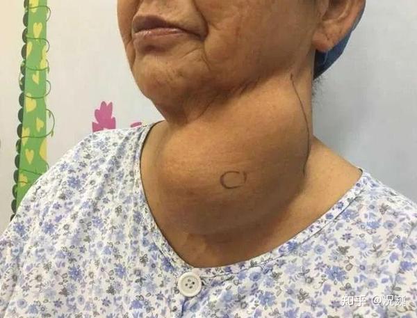 年轻女子患甲状腺癌,警告:甲状腺癌晚期,4个反常别大意