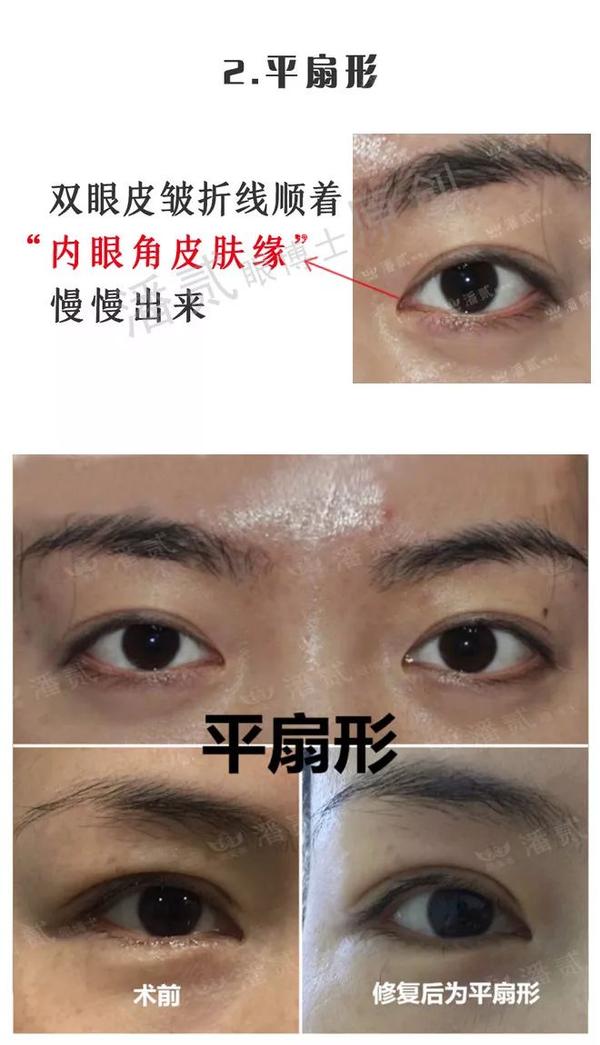 双眼皮形状分类!为什么不主张中国人做欧式平行双眼皮