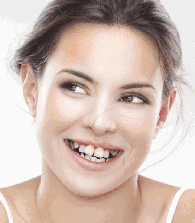 牙齿矫正为什么要经历洗牙补牙拔牙三部曲