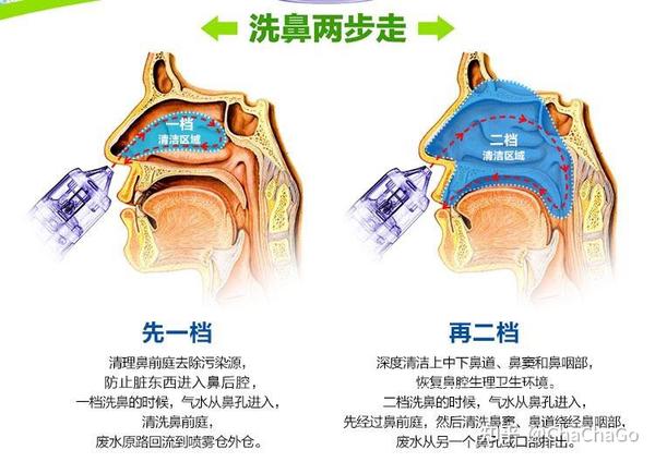 鼻炎患者福音|过敏性鼻炎|2021洗鼻器/洗鼻壶/洗鼻盐推荐