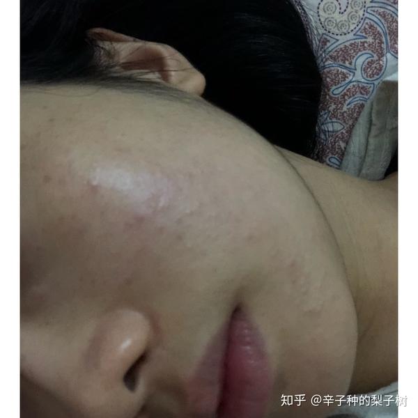 脸上长了很多又红又痒逆光疹子,有些透明的尖头看起来