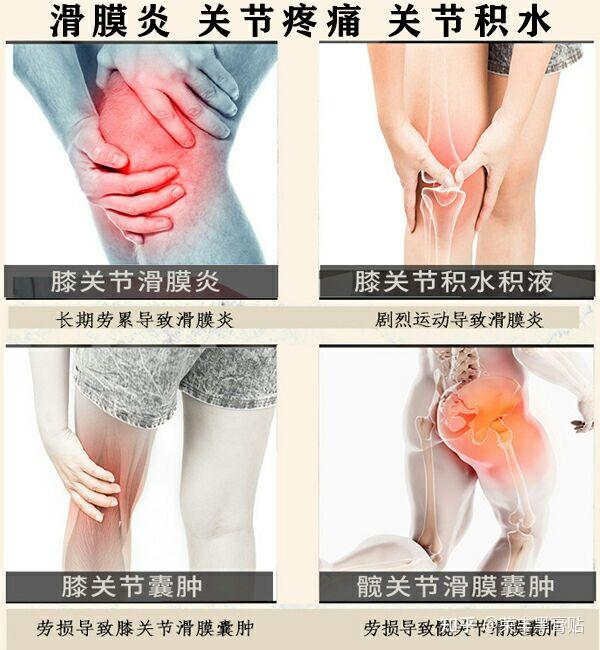 膝盖滑膜炎危害大四点危害需要患者注意