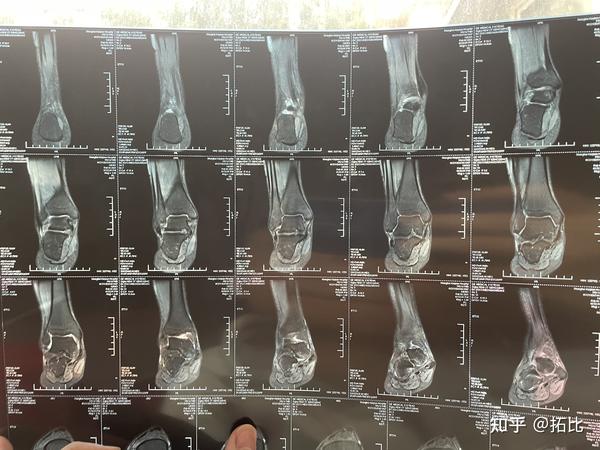 足舟骨及足跟骨撕脱性骨折2个月后的脚踝核磁共振图,算不算严重?
