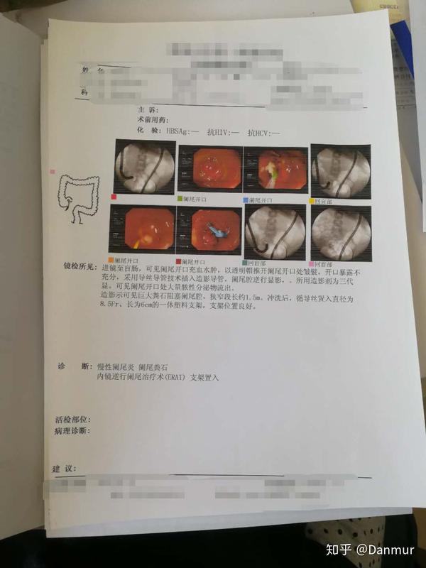 慢性阑尾炎 三次住院治疗 支架 腹腔镜微创