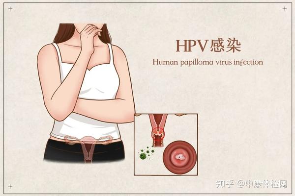 怎样知道自己有没有感染hpv病毒?预防hpv病毒这样做!