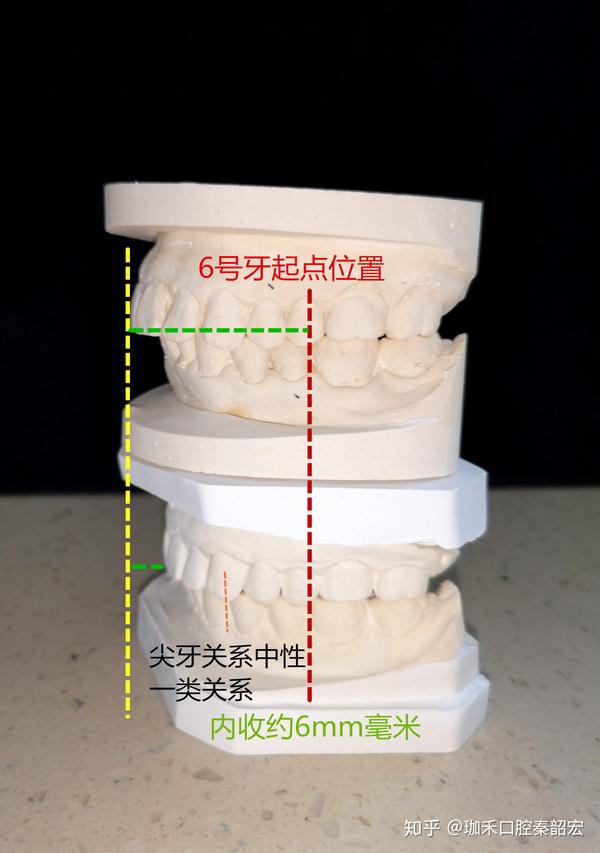 如图,分享的是两组矫正结束案例,通过片切不拔牙,术前术后,前牙齿内