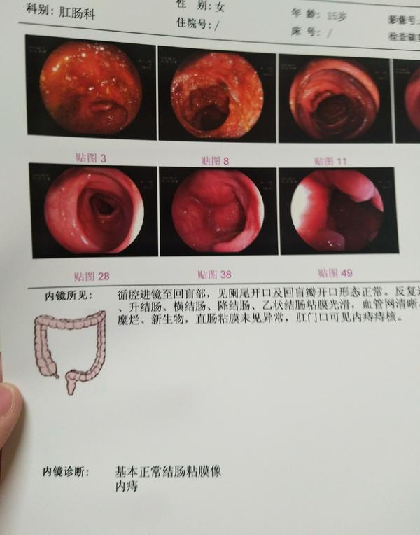 接受肠镜检查是一种怎么样的体验?