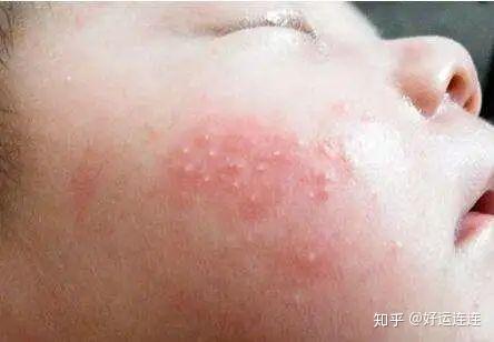 4,湿疹流水很严重,特别是流黄水,表面结黄色痂皮并且出现发烧症状时