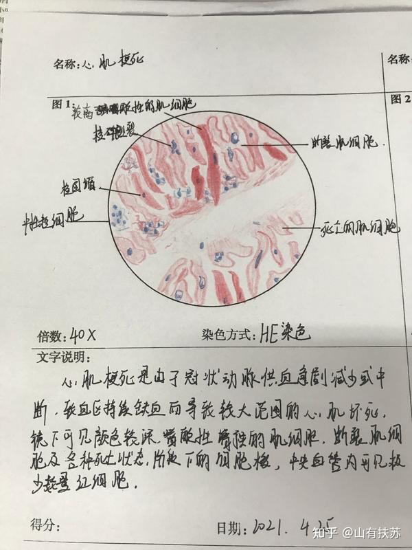 4.心肌梗死