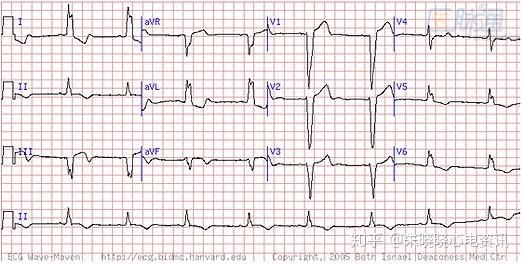 熟悉心肌梗死或缺血的经典心电图表现:st段改变,t波倒置和病理性q波