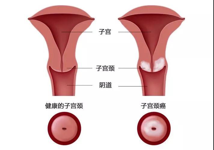 再说一遍宫颈糜烂不是病不是病