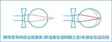 可以对动物眼睛的生长起到截然相反的诱导作用: 远视离焦(即成像在