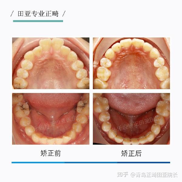 青岛牙齿矫正,深覆合深覆盖正畸案例