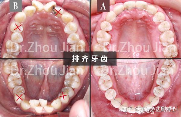 3年"蜕变 重度拥挤 大量坏牙,高难度矫正案例