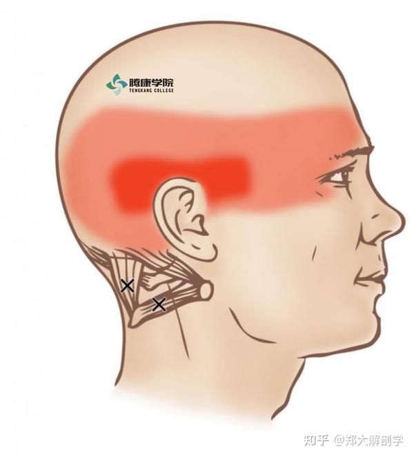 枕下肌群损伤导致头痛