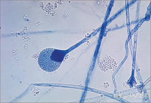 印度毛霉菌染色活检图像 @《柳叶刀》