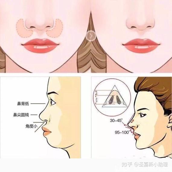 黄海滨解答眼鼻整形中的常见问题第四弹