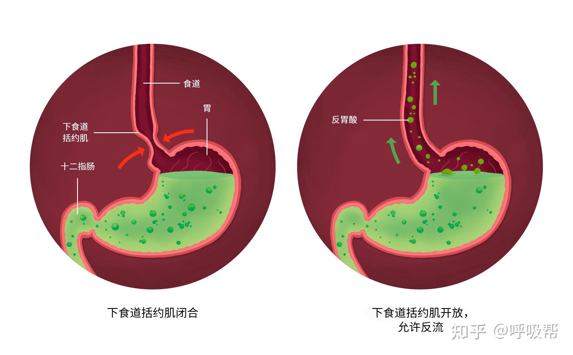 阻塞型睡眠呼吸暂停与胃食道逆流