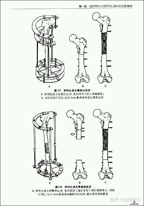 男生为长高做断骨增高术或面临残疾后果什么是断骨增高你如何看待这个