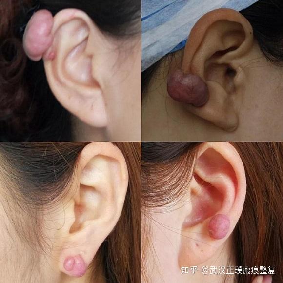 疤痕疙瘩通常会长在上半身,好发于前胸,后背,肩膀,双侧下颌缘,耳朵等