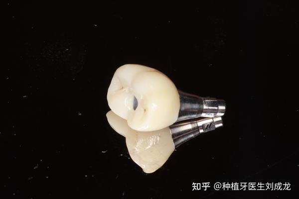 郑州瑞士iti种植牙医生刘成龙:下颌磨牙区单颗种植修复案例