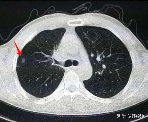 得了肺结节,该怎么办?平常需要注意什么?