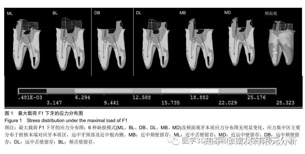 在 4 种载荷下,分别比较牙本质 mohr 应力分布及牙本质最大 mohr 值.