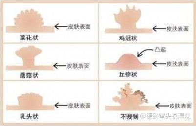 尖锐湿疣患者最关心的9个问题——(二)