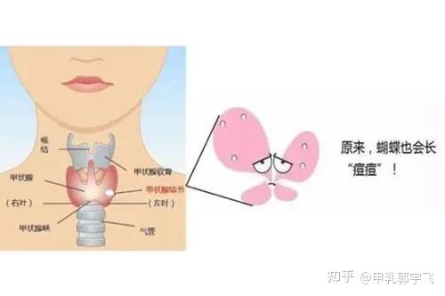 25岁姑娘2年没复查,甲状腺结节变成癌:为什么我总是长