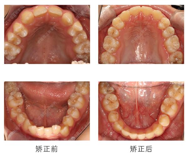 深圳牙齿矫正案例欧容霞篇│上颌先天缺失侧切牙下颌拥挤案例