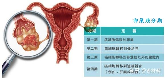 卵巢癌早期多无症状,当卵巢癌肿瘤体积长到一定大小时,会出现一些症状