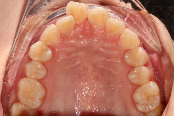 设计想法:患者自觉面型前突,上前牙突出,下颌骨内埋伏的牙齿无法牵出