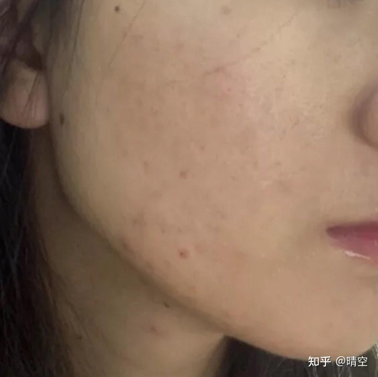我脸上好多痘印怎么去除呀