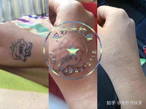 皮秒洗纹身