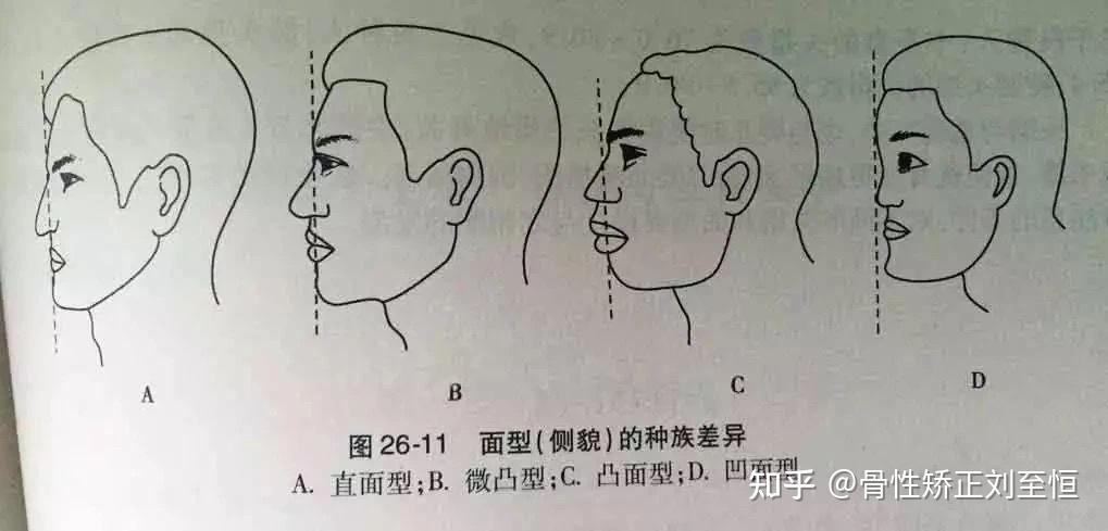 如何判断自己嘴凸
