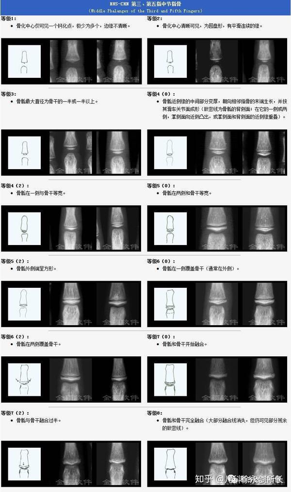 【中华05标准】解析儿童骨龄片等级划分