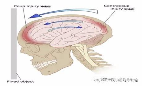 现役飞行员颅脑损伤系列七:头皮损伤和脑震荡