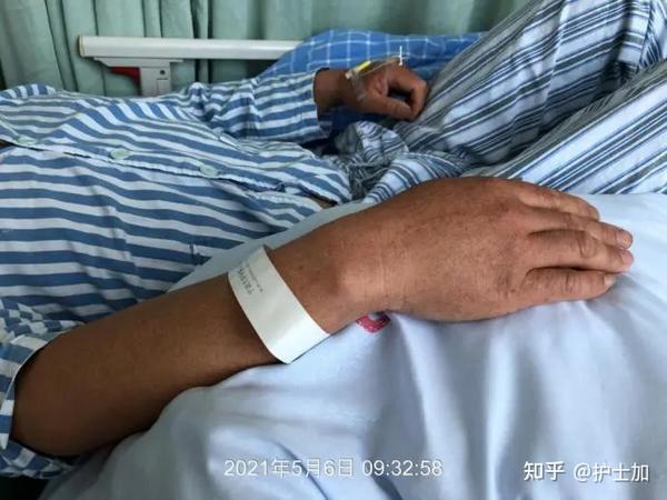 因"发现颌下淋巴结肿大1月余"入院,为进一步明确诊断,入院后在放射科